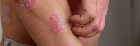 Traitement Psoriasis sans ordonnance