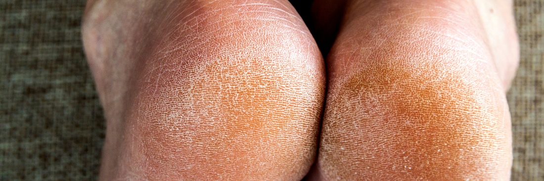 Prendre Soin de Ses Pieds :Notre Crème pour les Pieds Sec