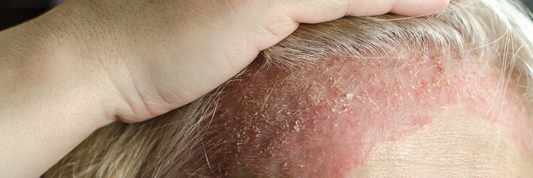 Prendre soin du Psoriasis des Cheveux avec Notre Shampoing Spécialisé
