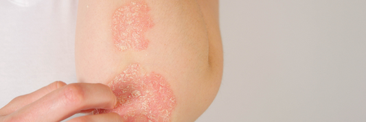 Crème Eczéma sans Cortisone : Soulagement des Démangeaisons et des Rougeurs